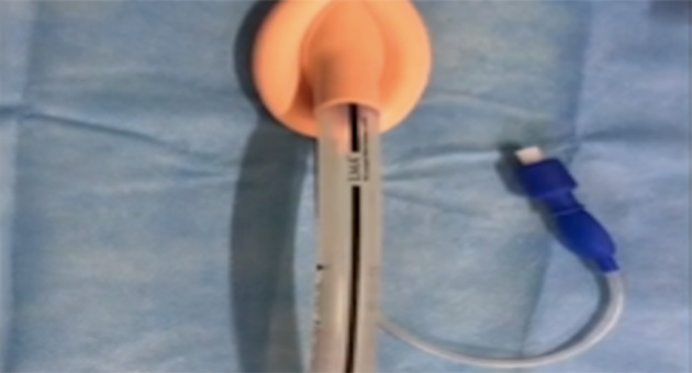 Laryngeal Mask Airway Insertion 