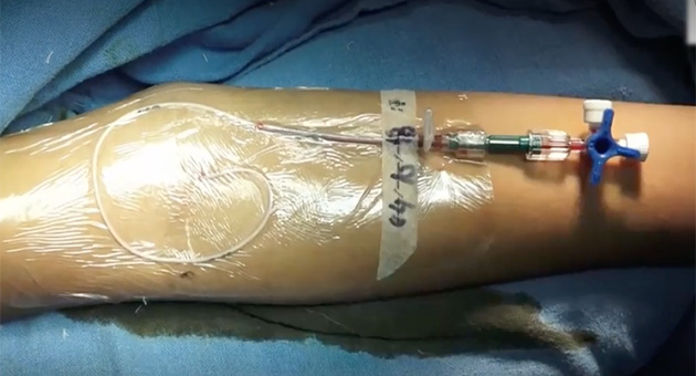Peripherally Inserted Central-venous Catheter