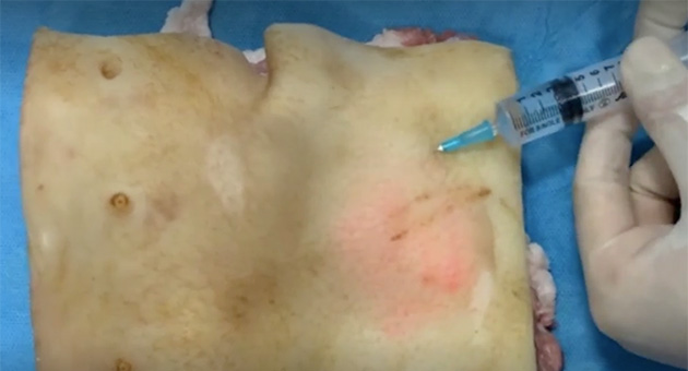 Incision and Drainage of a Superficial Abscess