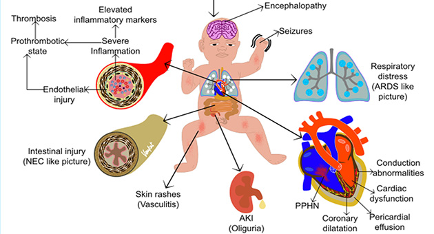 Multisystem Inflammatory Syndrome in Newborns (MIS-N)