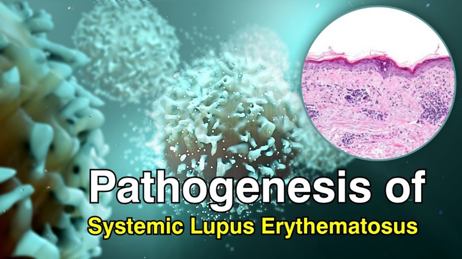 Pathogenesis of Systemic Lupus Erythematosus 