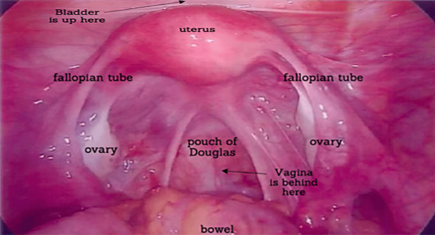 Endometriosis